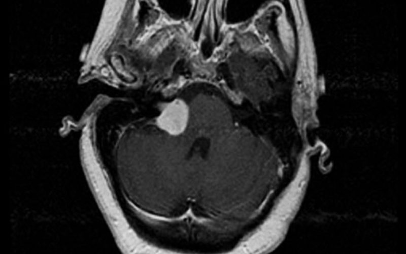 Diferencias entre un schwannoma y un neurofibroma