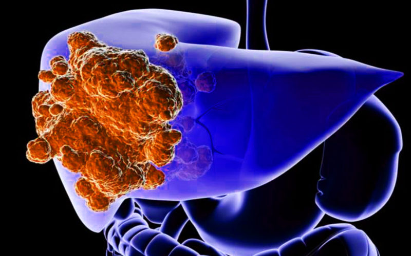 Diferencias entre el cáncer de hígado y la cirrosis hepática