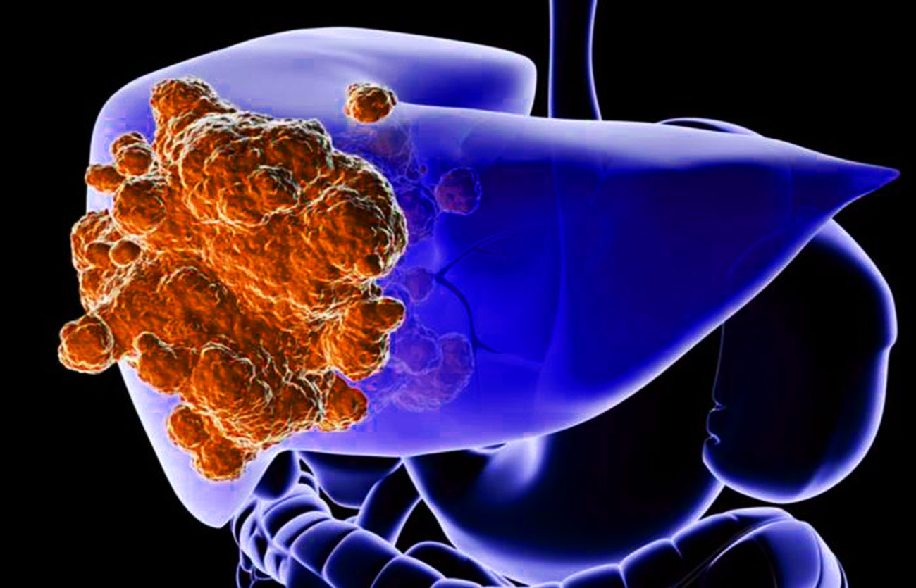 Diferencias entre el cáncer de hígado y la cirrosis hepática