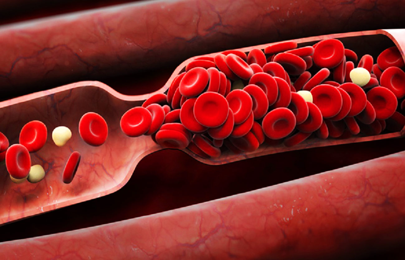 Diferencias entre el coágulo de sangre y el calambre en la pierna