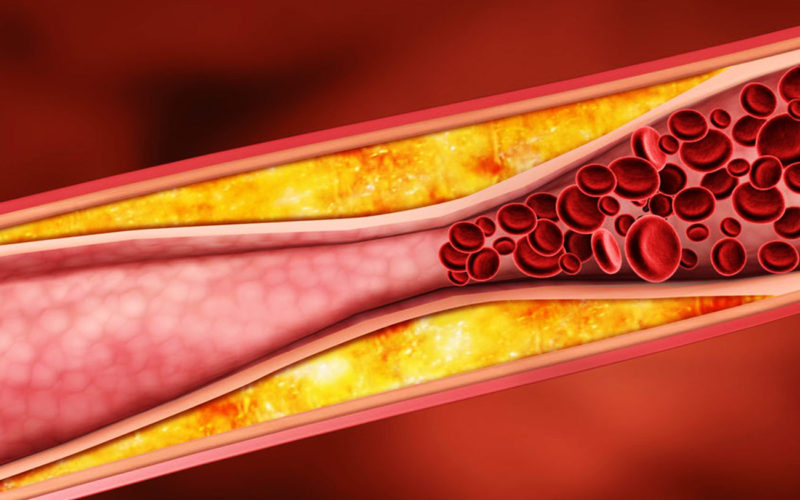 Diferencias entre la aterosclerosis y el ateroma