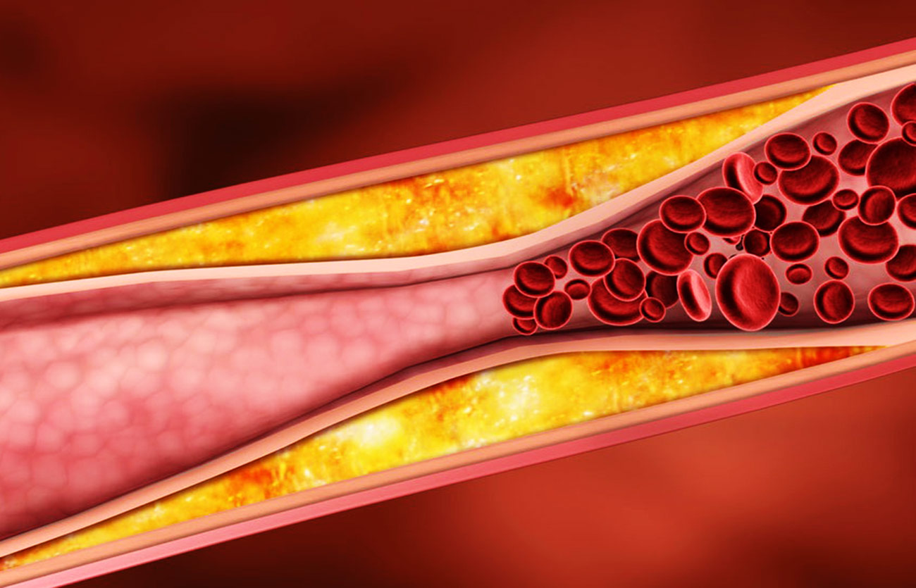 Diferencias entre la aterosclerosis y el ateroma