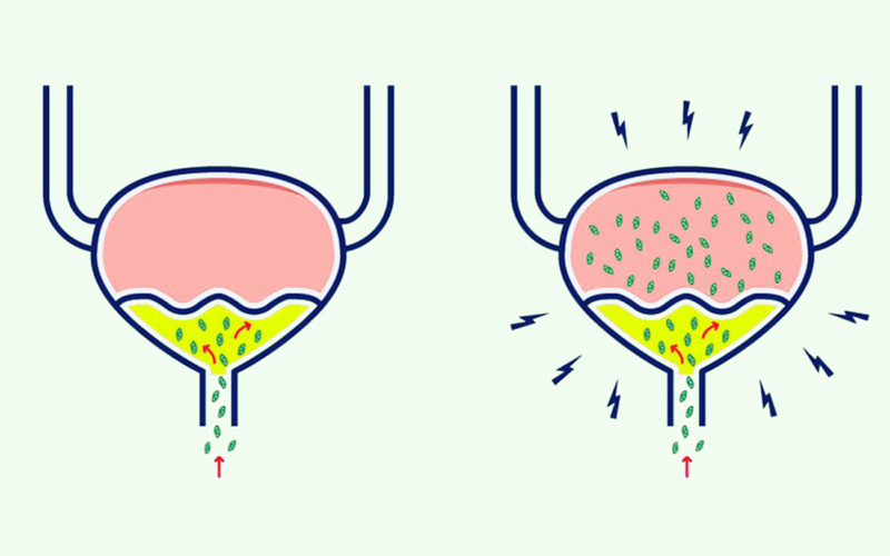 Diferencias entre la infección de vejiga y la infección urinaria