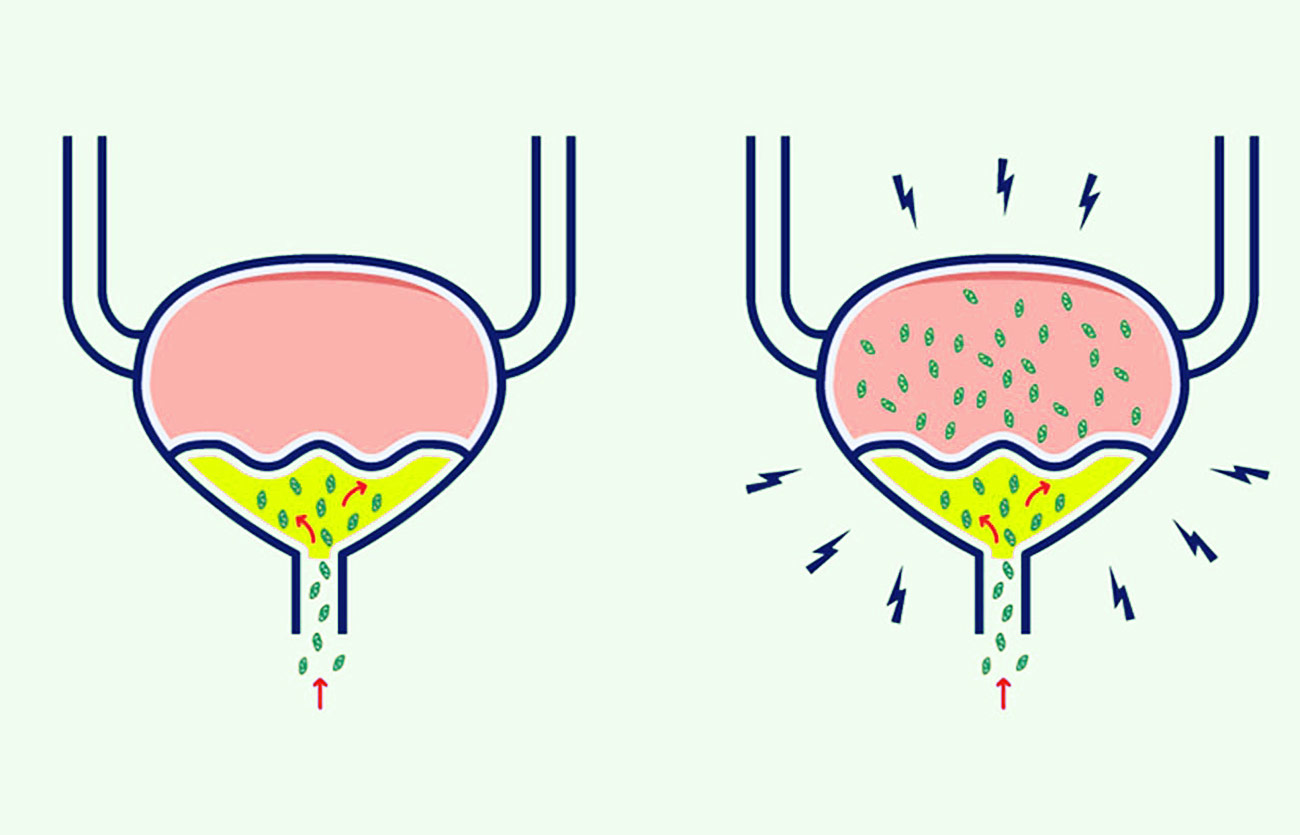 Diferencias entre la infección de vejiga y la infección urinaria