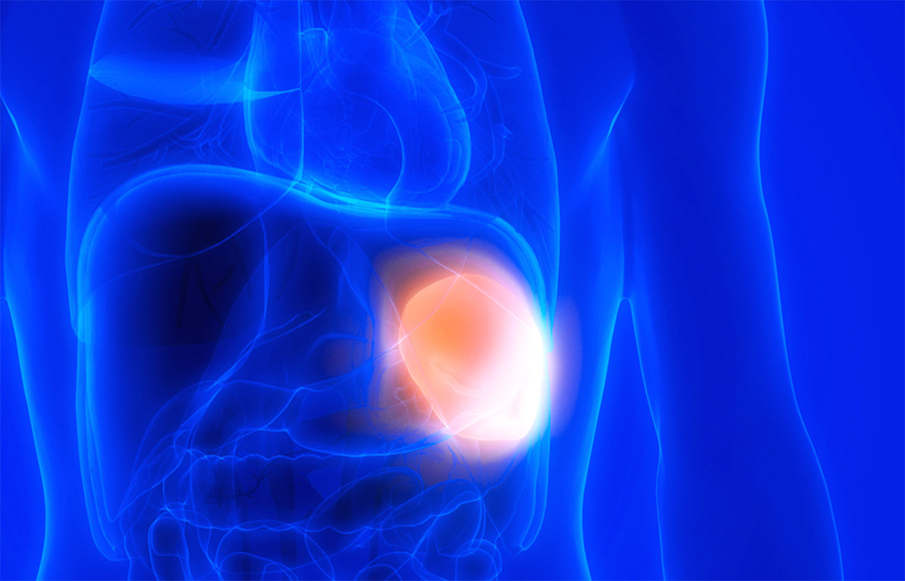 Diferencias entre esplenomegalia e hiperesplenismo