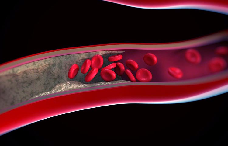 Diferencias entre arteriosclerosis y aterosclerosis