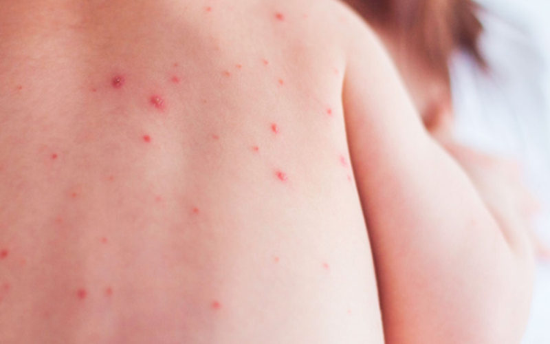 Qué síntomas tiene la varicela
